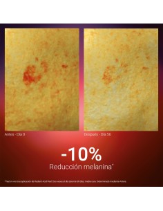 SINGULADERM Radiant Acid Peel 10 ml 2