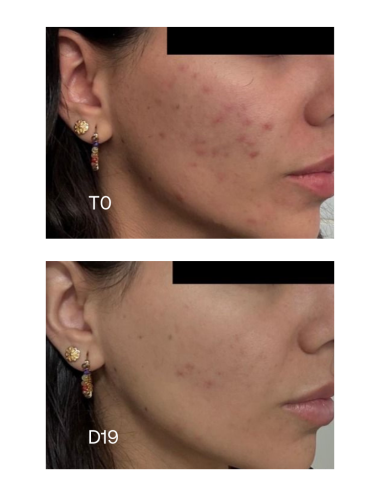 SENSILIS Pure 15AZ Sérum Concentrado Global Anti-Imperfecciones 30 ml
